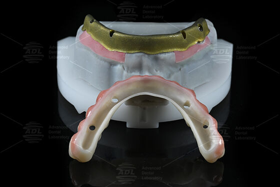 購入 中国歯科ラボ ほとんどの歯科インプラントシステムと互換性あり 全4種 72時間以内に提供 オンライン製造