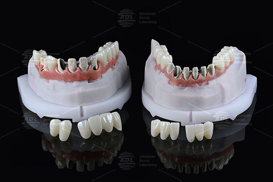 購入 中国歯科ラボ チタン フルアーチ ハイブリッドブリッジ 即時負荷 A1シェード マロンデザイン スクリューリテンション CAD/CAM オンライン製造