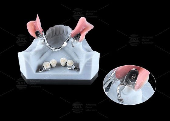 0.1mm 許容量 CEKA REVAX 付着物 チタン 3mm 垂直クリアランス