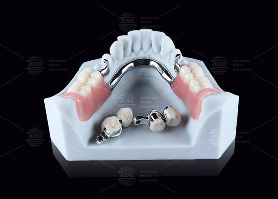 CEKA M2 精密アタッチメント タイタン 3mm 縦横空隙